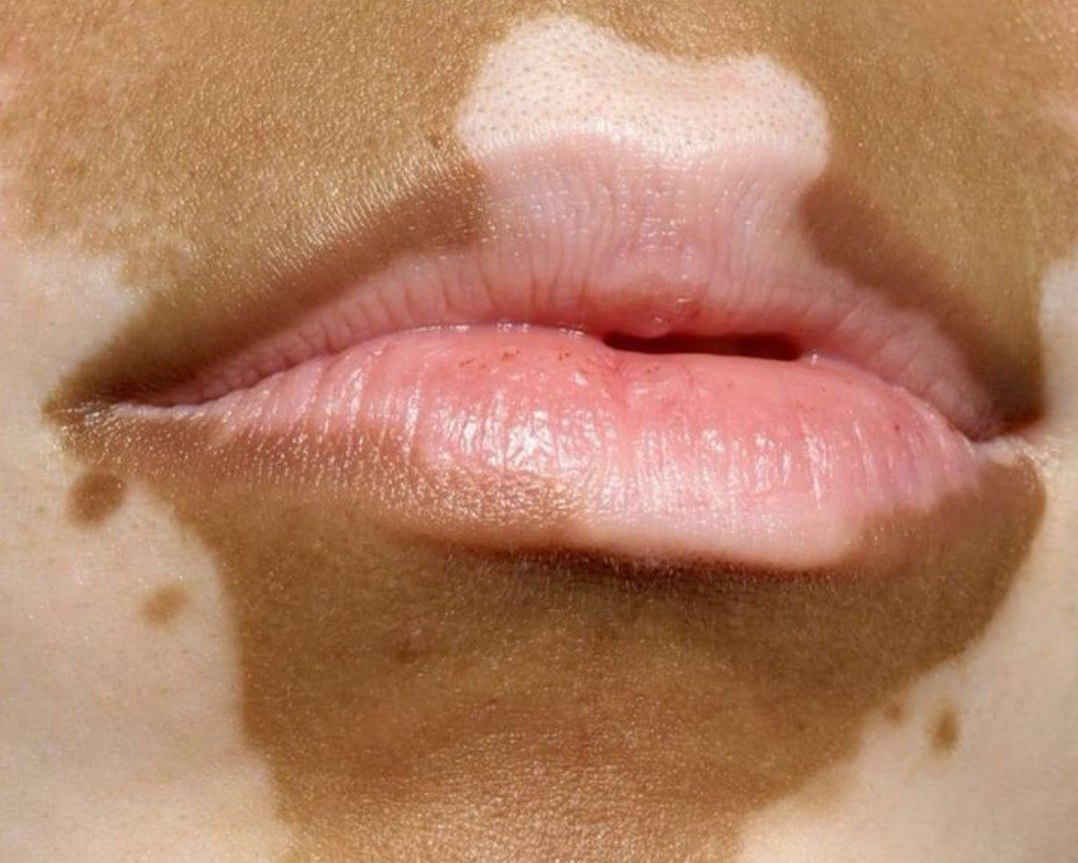 SENSITIVE SKIN DESERVES SUMMER TOO